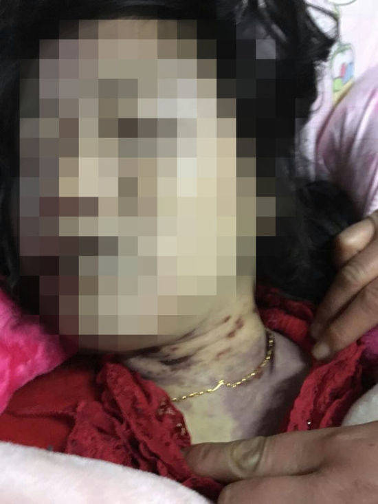 孕妇遭家暴被掐死未下葬 尸体照片曝光颈部淤痕触目惊心